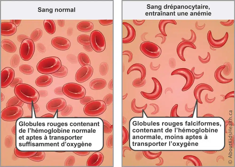 L’impact social de la drépanocytose et le rôle de la communauté